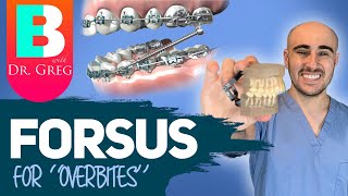 Braces Forsus for Overbite Overjet Correction [upl. by Enaols]