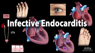 Infective Endocarditis Animation [upl. by Marlow77]