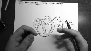 WolffParkinsonWhite Syndrome [upl. by Illa333]