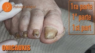 Onicauxis onychomycosis amp callosities Part 1 podologiaintegral [upl. by Airdnoed]