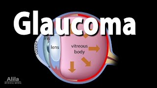 Development of Glaucoma Animation Open Angle vs Angle Closure Glaucoma [upl. by Gran307]