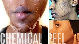 HOW TO Make a NATURAL Chemical Peel AT HOME  ERASE ACNE WRINKLES amp DARK SPOTS [upl. by Simetra]