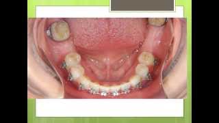 Orthodontics Treatment Before Dental Implants [upl. by Sac]