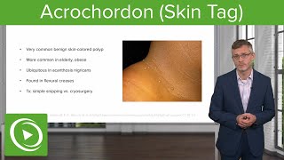 Acrochordon Skin Tag Dermatology  Lecturio [upl. by Asirrak768]