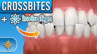 Can Invisalign Fix Crossbites [upl. by Eneliak]