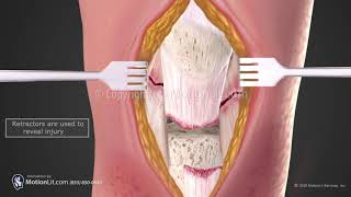 Patella Tendon Repair [upl. by Aketal]