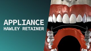 Appliance  Hawley Retainer Procedure [upl. by Mountford162]