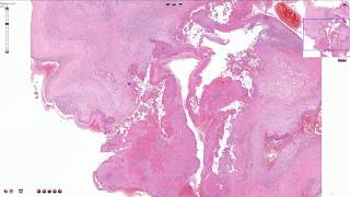 Infective Endocarditis  Histopathology [upl. by Nnovahs941]