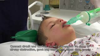 Paediatric Anaesthetics Chapter 2  LMA insertion 1 [upl. by Rici]