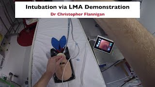 Intubation via LMA Demonstration [upl. by Boff]