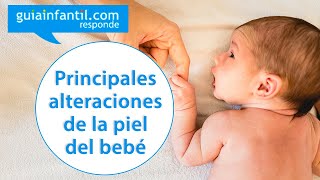 Sudamina y acné neonatal Principales alteraciones de la piel del bebé  Guiainfantil responde [upl. by Yremrej]