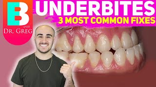 BRACES EXPLAINED Underbite  Crossbite Correction [upl. by Erinna6]