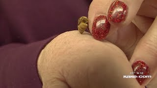 Woman uses bee venom to treat arthritis [upl. by Alleen]