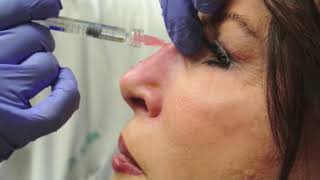 Nonsurgical Rhinoplasty [upl. by Senzer]