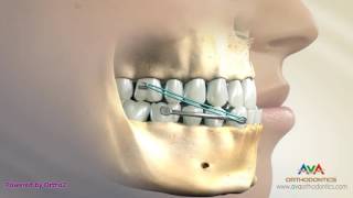 Orthodontic Treatment for Underbite or Crossbite  Carriere Appliance [upl. by Irotal]