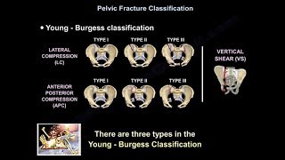 Pelvic Fractures  Everything You Need To Know  Dr Nabil Ebraheim [upl. by Eninaj790]