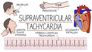 Understanding Supraventricular Tachycardia SVT [upl. by Karlene803]