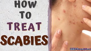 HOW TO TREAT SCABIESscabies treatment at home [upl. by Avahc491]