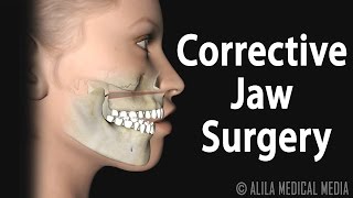 Corrective Jaw Orthognathic Surgery Animation [upl. by Ynohtnad997]