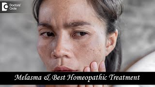 MELASMA OR CHLOASMA  Causes and Best Homeopathic Treatment  Dr V Bhagyalakshmi  Doctors Circle [upl. by Hayikaz850]