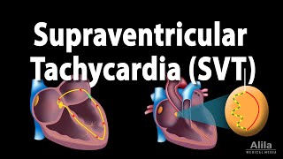 Supraventricular Tachycardia SVT PSVT Animation [upl. by Nirra]