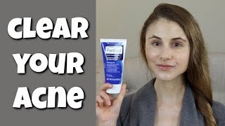 HOW TO CLEAR YOUR SKIN WITH BENZOYL PEROXIDE DR DRAY [upl. by Fenton]