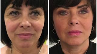 HIFU NonSurgical Face Lift Treatment  Client Testimonial  Hazel [upl. by Anneliese572]