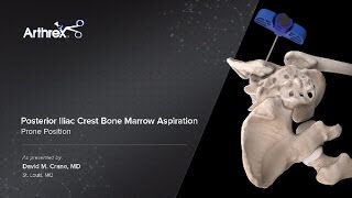 Posterior Iliac Crest Bone Marrow Aspiration  Prone Position [upl. by Schechinger]