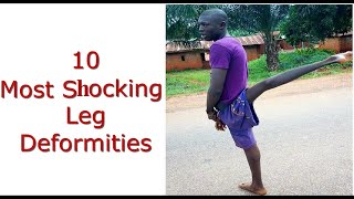 10 Most Shocking Leg Deformities [upl. by Okimat]