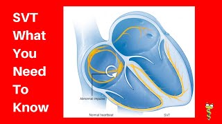 Supraventricular Tachycardia SVT [upl. by Tail]
