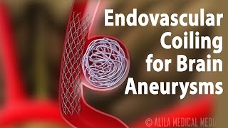 Endovascular Coiling for Brain Aneurysm Animation [upl. by Wedurn378]