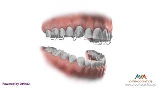 Orthodontic Retainer  Hawley  Instruction and Care [upl. by Vasiliki]