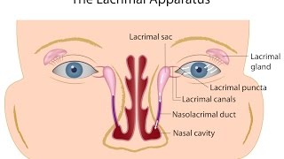 Nasolacrimal Duct Obstruction [upl. by Enirehtahc]