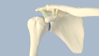 Acromioclavicular Separation Surgery [upl. by Lovash]