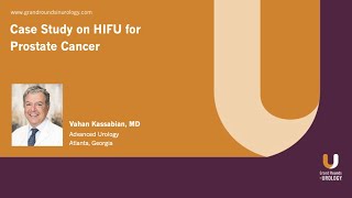 Case Study on HIFU for Prostate Cancer [upl. by Ysor522]