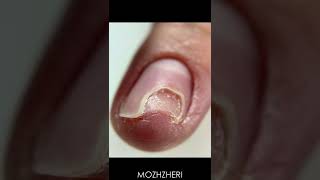 Toenail Trauma  Onycholysis  Cleanup [upl. by Ydnec18]