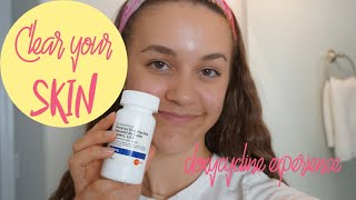 How To Get Rid of Acne  My Doxycycline Experience [upl. by Severn]