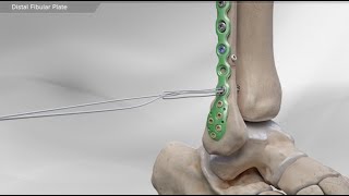 Distal Fibular Plate [upl. by Ioved835]