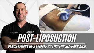 Post Liposuction  Venus Legacy RF  Female HD Lipo  Six Pack  West Hollywood CA  Dr Jason Emer [upl. by Delcina367]