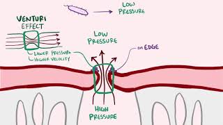 Endocarditis infective libman sacks causes symptoms treatment amp pathology [upl. by Elocaj]