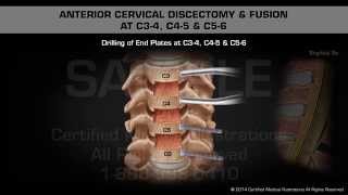 Anterior Cervical Discectomy amp Fusion at C34 C45 amp C56 [upl. by Becket]