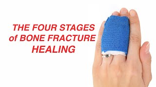 The Four Stages of Bone Fracture Healing [upl. by Akiehsat]