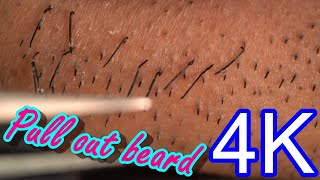 Beard removal tweezers super high quality zoom ASMR [upl. by Nosaj358]