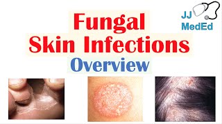 Overview of Fungal Skin Infections  Tinea Infections [upl. by Hawker]