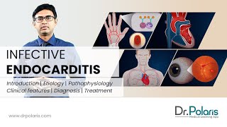 INFECTIVE ENDOCARDITIS  Etiology Pathophysiology Clinical Features Management  Animated [upl. by Toiboid]