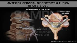 Anterior Cervical Discectomy amp Fusion at C56 amp C67 [upl. by Itsur]