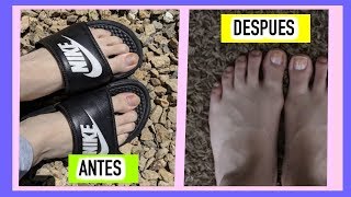 CÓMO BLANQUEAR UÑAS AMARILLAS DE LOS PIES [upl. by Saduj]