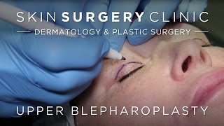 Upper Blepharoplasty Eyelid Surgery  Watch the Procedure [upl. by Ehrsam]