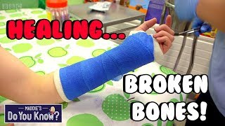 How do you make a Plastic Cast for Broken Bones 🏥 Maddies Do You Know 👩 [upl. by Sebastiano480]