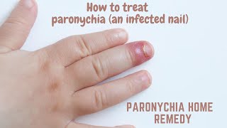 Paronychia home remedy  How to treat paronychia an infected nail [upl. by Conlin]